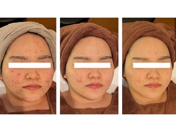 ミベル(MeBell)/【ニキビケア】ハーブリプロ