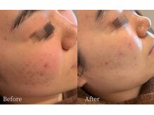 サロンドポノ(Salon de Pono)の雰囲気（ニキビ集中コース【¥6,600】Before /After）