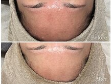 TD 鵜沼店/ハーブピーリング