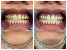 コナホワイトニング 神保町/ホワイトニング