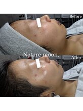 ナチュールムーン(Nature moon.)/ハーブピーリング after