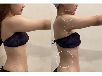ラヴニール(L'avenir)/二の腕のたるみ腰回りのお肉改善