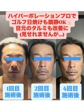 痩身ハイパーナイフメンズ【salon blue rose】新栄町/千種/痩身/ダイエット/脂肪燃焼/メンズフェイシャル/小顔/エステ