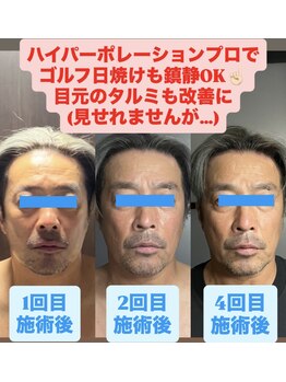 痩身ハイパーナイフメンズ【salon blue rose】新栄町/千種/痩身/ダイエット/脂肪燃焼/メンズフェイシャル/小顔/エステ