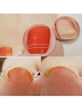 スピリチュアルネイル エム(spiritual nail M)/ドイツ式巻き爪