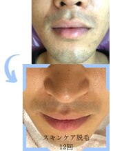 ミックスアップ 練馬店(Mix up)/「肌をキレイにする」脱毛効果