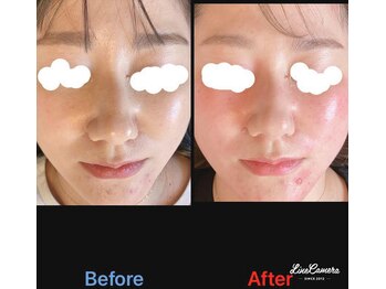 美容矯正サロン レレポノ(LELEPONO)/鼻の曲がりを矯正