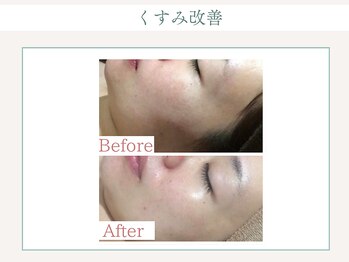 トータルビューティー ゆみえエステ(Total Beauty)/ハイパーナイフ フェイシャル