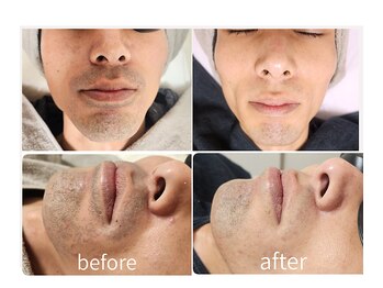 キレイラボ(Ki-Re-i LABO)/ヒゲ脱毛 メンズ