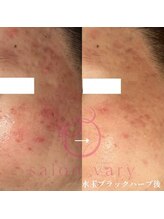 ヴェアリー 広尾(VARY)/こめかみやほほニキビ