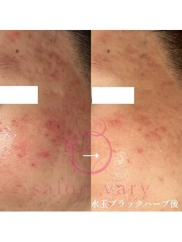ヴェアリー 広尾(VARY)/こめかみやほほニキビ