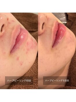 ビビ(VIVI)/繰り返す顎のニキビに