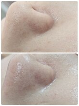 リセラージュ(Recellage)/SNSで話題の★肌育毛穴洗浄