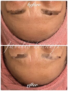 ファビリス 天王寺店(FAVILIS)/ACトリートメント1回/40代