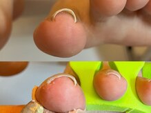 キラネイル アンド アイラッシュ by World Beauty(KIRA)/巻爪補正　ペディグラス