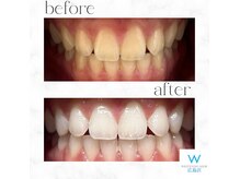 ホワイトニングショップ 広島店(WHITENING SHOP)の雰囲気（ホワイトニング後のお客様の歯です♪本格的ホワイトニング◎）