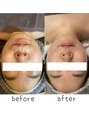 トモズサロン28(Tomos.salon.)&nbsp;シミ、肌荒れ改善ならホワイトハーブピーリングがおすすめ！
