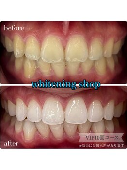 ホワイトニングショップ 桜木町店/【月に2回、6ヶ月来店】