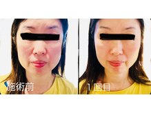 サロンモコ(Salon Moco)の雰囲気（毛穴／小顔／リフトアップ／ほうれい線／美白／）