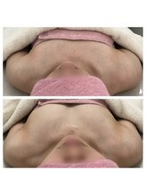 サロンドコーデ(salon de co-de)/バストアップ症例☆