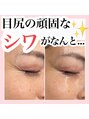 アルムダアクア 天王寺店(Aleumda AQUA)&nbsp;ハーブピーリング/REVIハーブピーリング/毛穴/ニキビケア/小顔