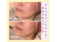 アールアンドエス(R&S)の雰囲気（【リフトアップ】糸で引き上げたようなリフトアップへ☆）