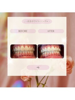 プラスビー 2号店(+b)/ホワイトニングビフォーアフター