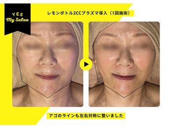 イエス マイサロン(yes My Salon)/レモンボトル施術例