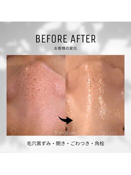 フランジパニ(FRANGIPANI)の写真/毛穴でお悩みの方に◎小鼻の黒ずみや古い角質を除去！溢れるような潤い、透明感、艶美肌へ♪