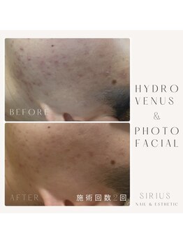 シリウス(Sirius)/ハイドロ+光フェイシャル