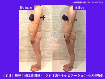 フェレザ 新潟(Felleza)/1回目から効果も♪※個人差あり