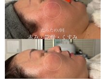 オーシャンブルーム 目黒(OceanBloom)/赤み乾燥くすみ