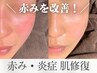 ＜赤みのお悩みに｜初回限定4回セット＞赤み集中修復コース｜保湿・乾燥肌