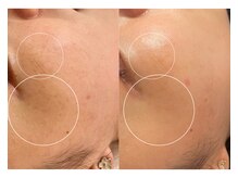 モネ(monet)/シミケア