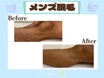 ヴィ シェーン(Vi Schoen)/【メンズ足脱毛】Before/After