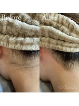 マベル シュガーリング(Mabelle)/うなじのW脱毛