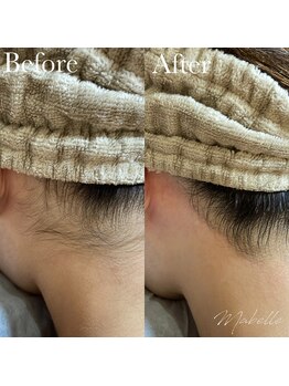 マベル シュガーリング(Mabelle)/うなじのW脱毛