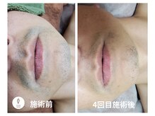 ヴォアール 名古屋店(VOIR)/メンズ脱毛　ヒゲ脱毛