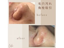 カラン(Calin)の雰囲気(毛穴汚れ角栓吸引で毛穴スッキリ♪)