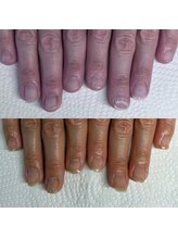 ウェルズユキ(well's yuki)/割れた爪/剥がれた爪/2枚爪