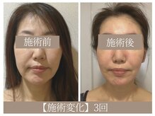 ドクターボディ 恵比寿店(Dr.Body)/【頬のたるみ/ほうれい線 50代】