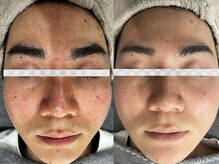 ヨハク(YOHAKU)/赤みにも効果的です！