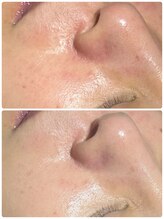 リゼ(RIZE)/幹細胞白玉トリートメント