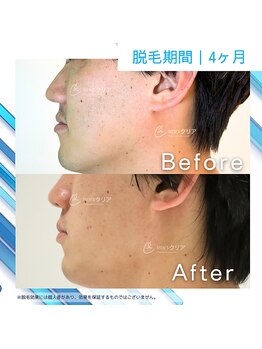 メンズクリア 高知帯屋町店/【メンズクリア】お客様の施術例