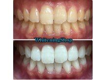 ホワイトニングショップ 水戸駅前店/#水戸ホワイトニング#水戸エステ