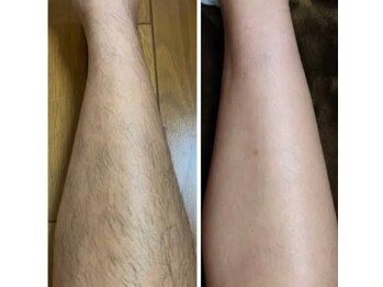 サーディン(sardine)/メンズ足脱毛