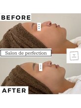 サロン ド パーフェクション(Salon de Perfection)/小顔リフト