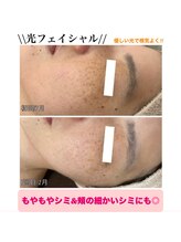 ココネイル 板山店(coco nail)/人気No.1連射式＊光フェイシャル