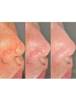 毛穴ケアをしたい