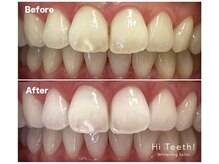 ハイティース 高田馬場店(Hi Teeth!)/医療提携セルフホワイトニング